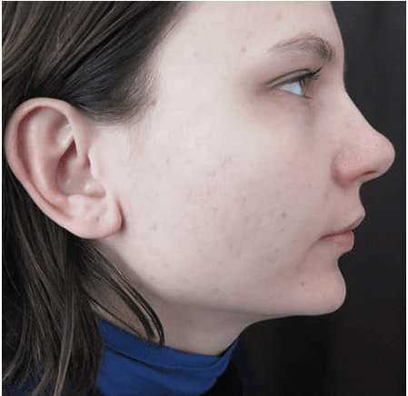 Treatment after outcome