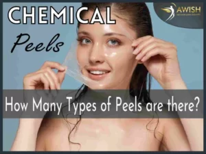 How many types of peels are there?