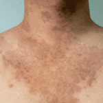 Tinea Corporis