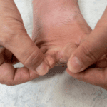 Tinea Pedis