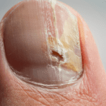 Tinea Unguium