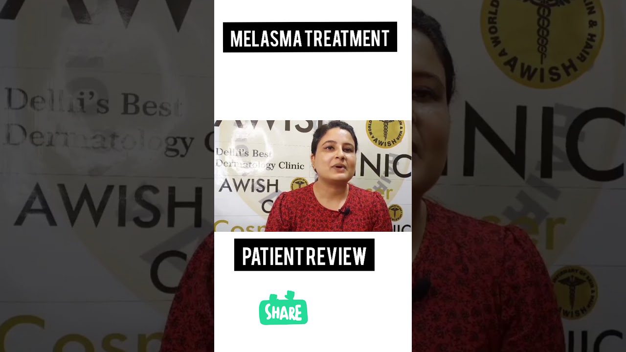 Melasma Treatment Genuine review