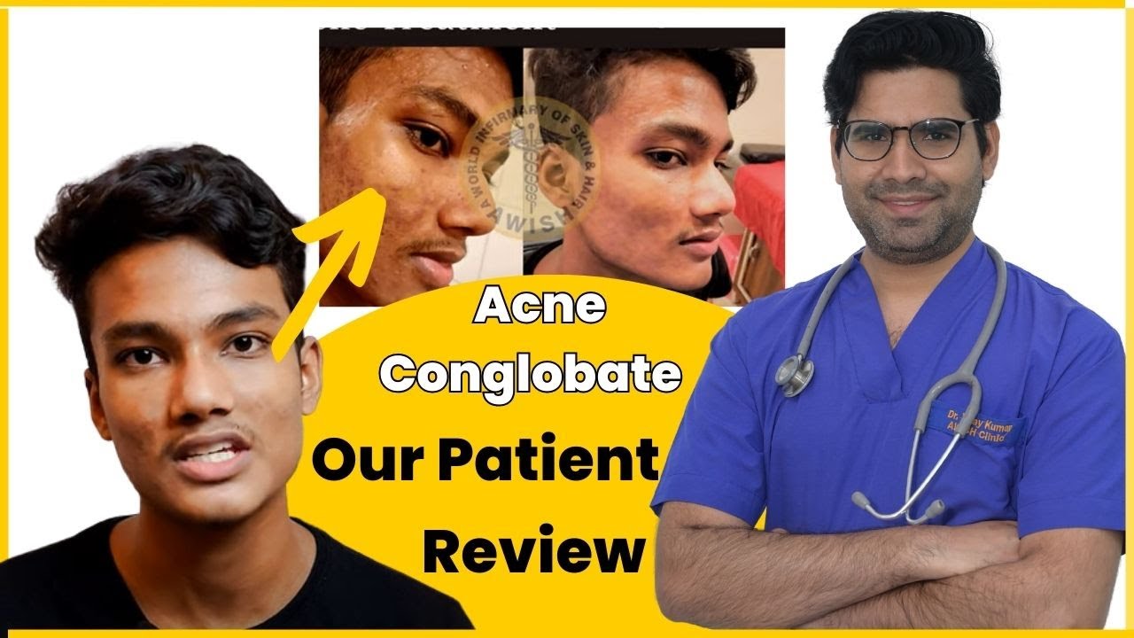 Acne Conglobata Treatment Review by Patient