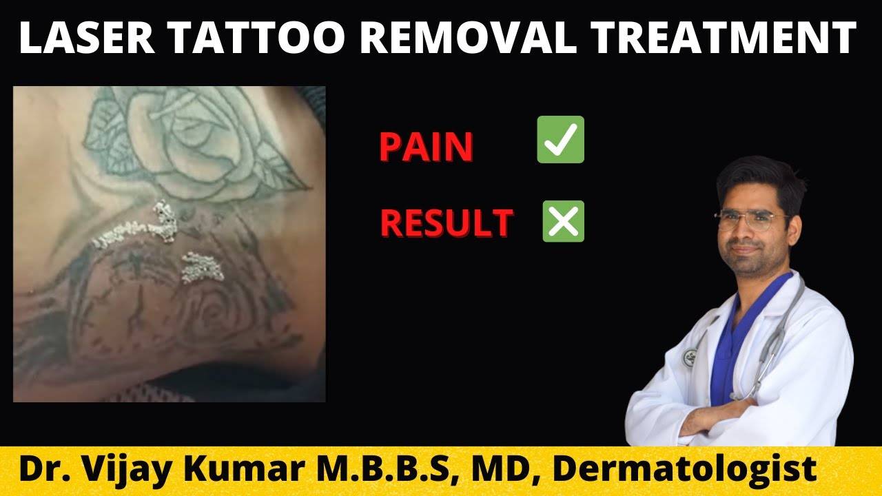 Tattoo Removal