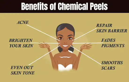 Benefits of Chemical Peels
